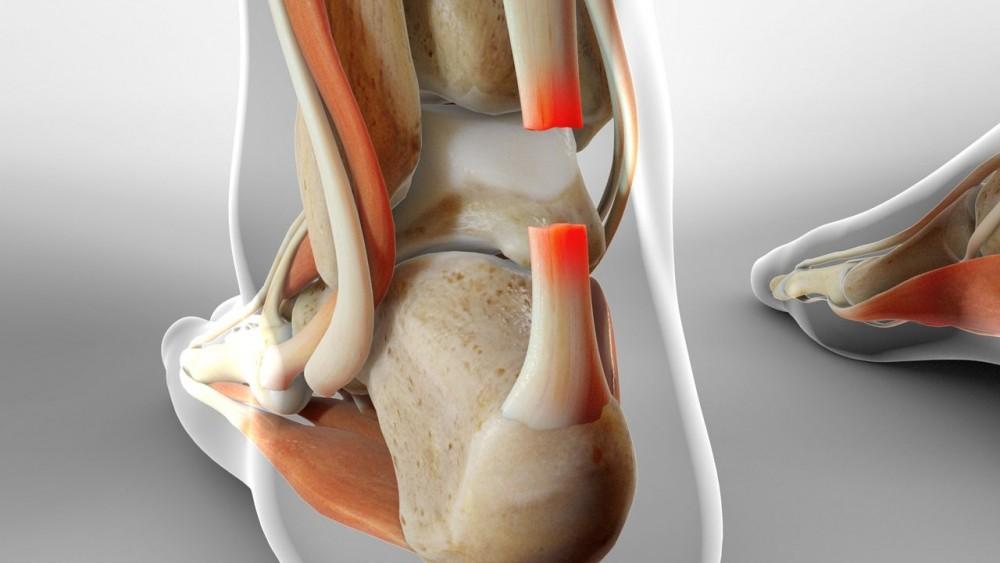 Achilles Tendon Repair
