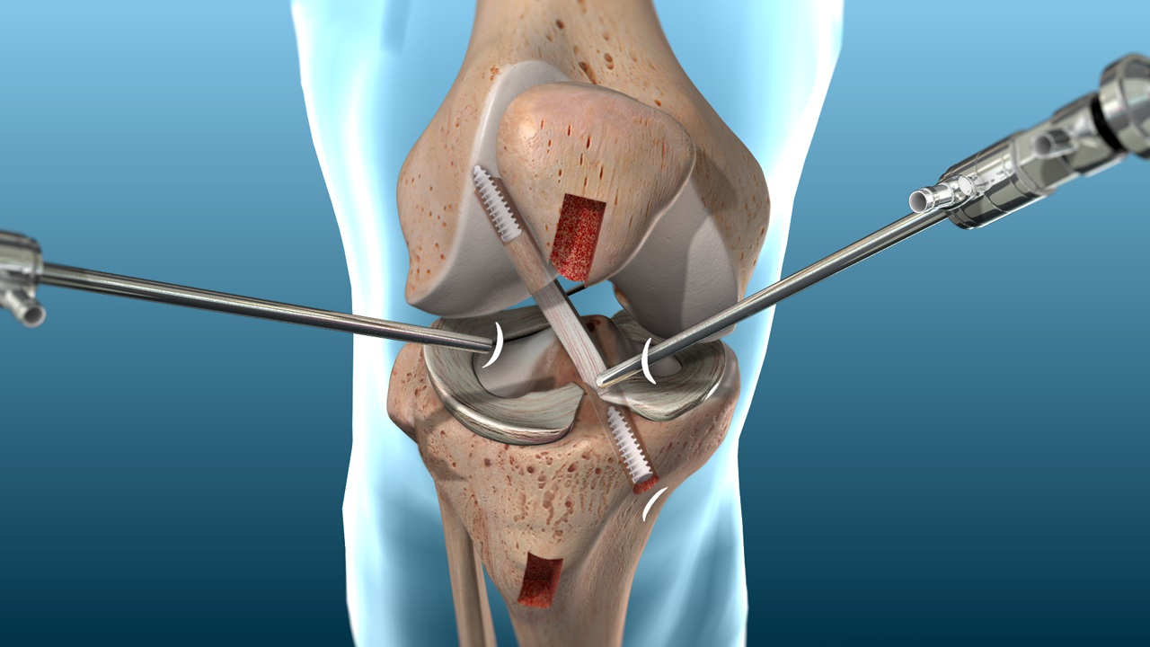 Sports Injury Specialist Kolkata & ACL Reconstruction - Dr. Vikrant Sinha Roy