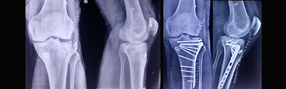 Orthopaedic Trauma Specialist Kolkata & Fracture Management - Dr. Vikrant Sinha Roy