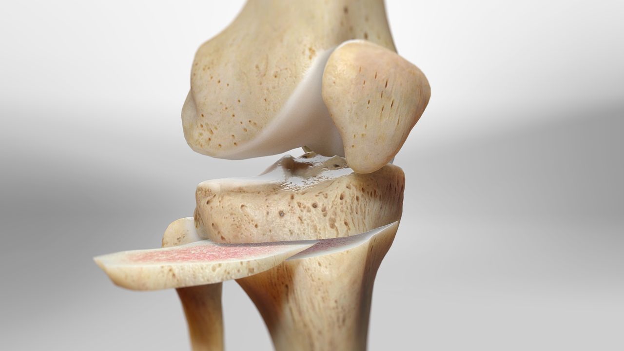 Joint Preservation via High Tibial Osteotomy