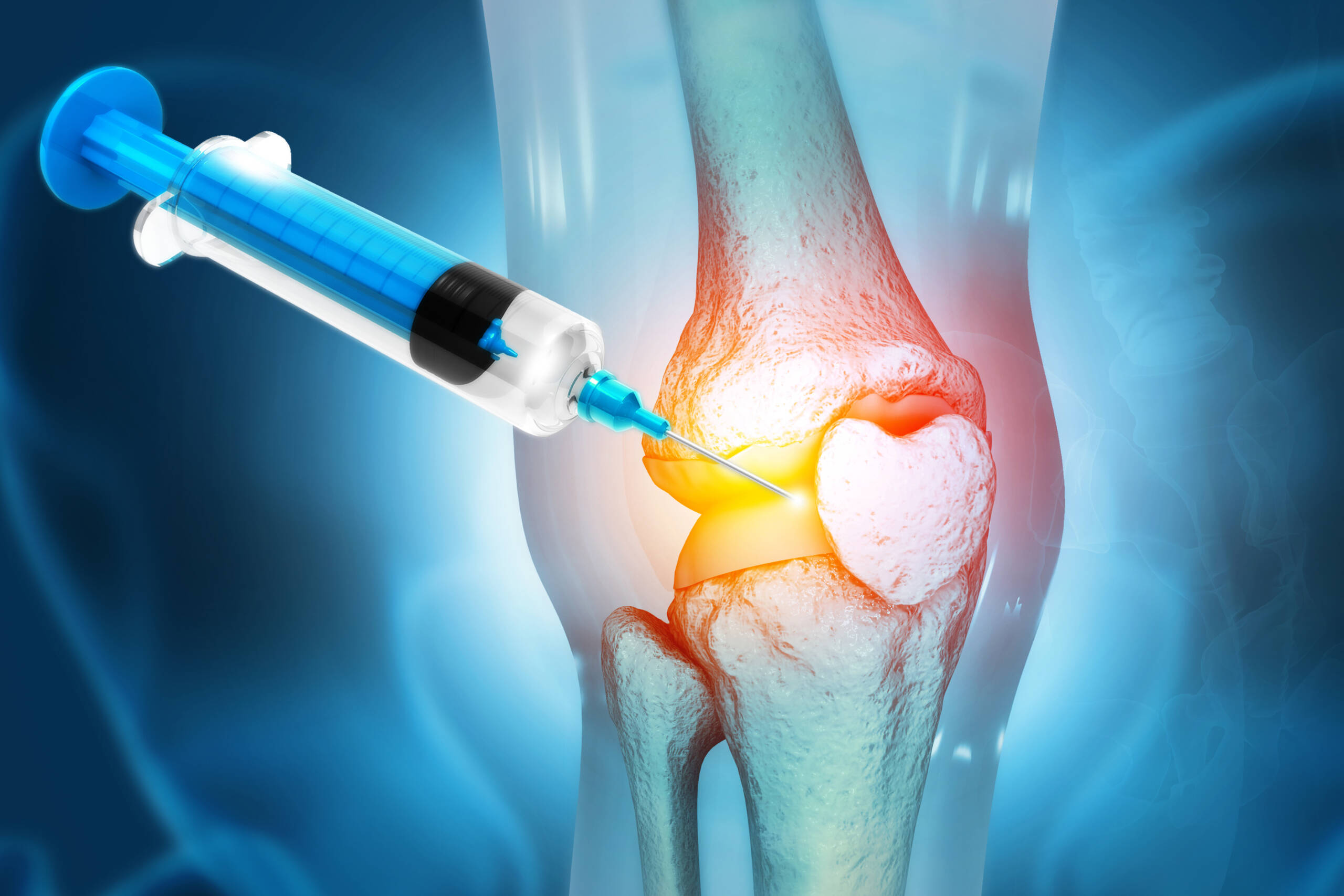 Intra-Articular Injections