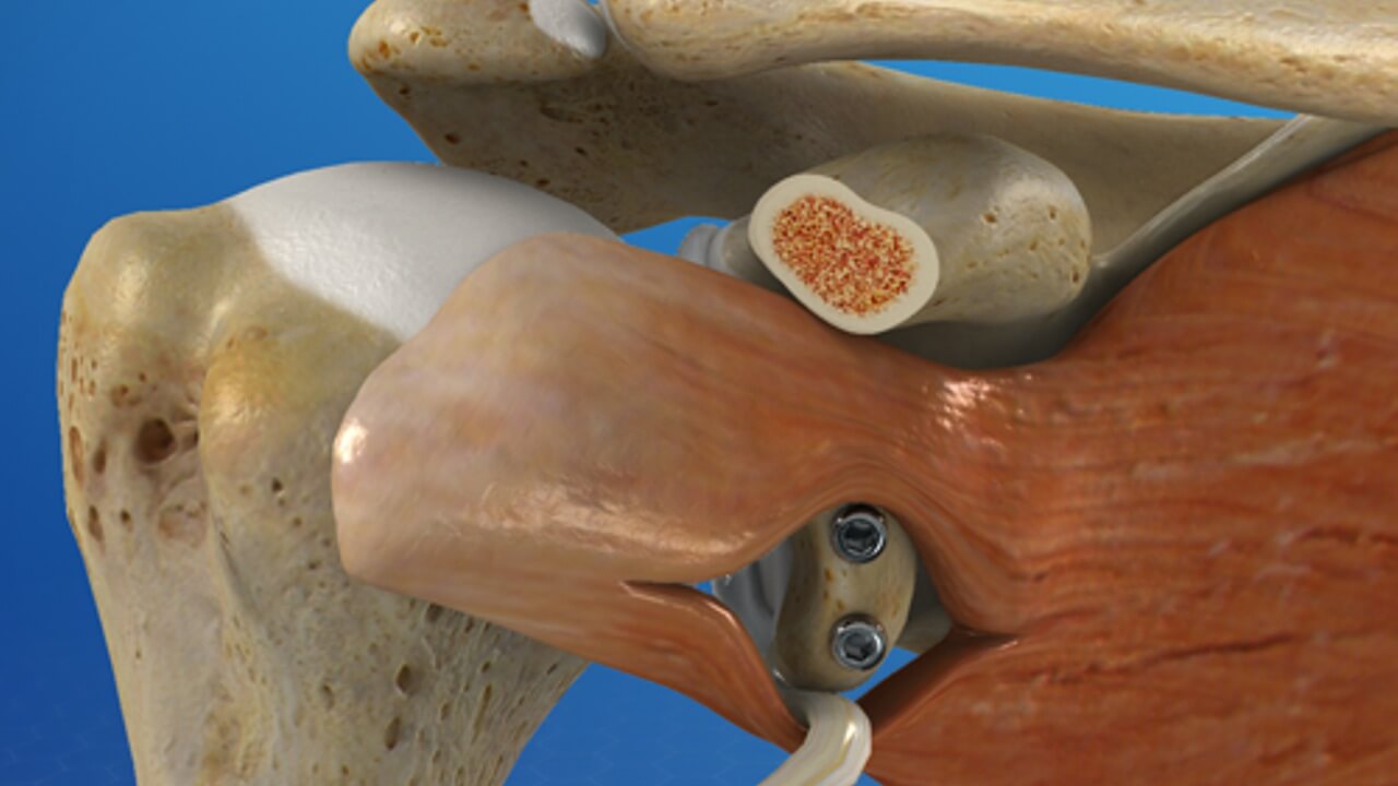 Latarjet Procedure