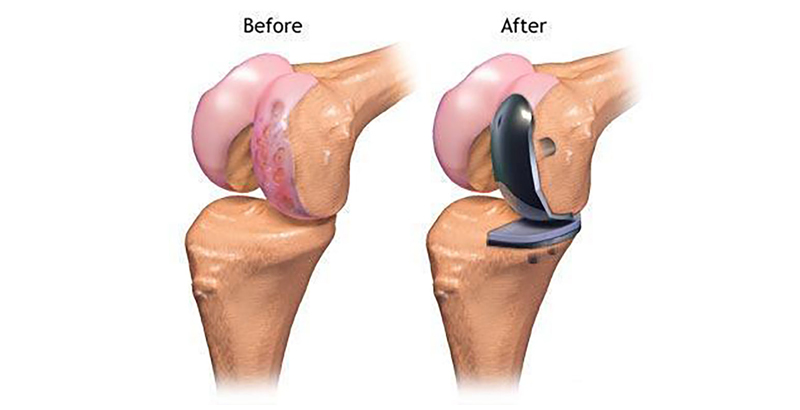 Why Partial Knee Replacement Feels More Natural