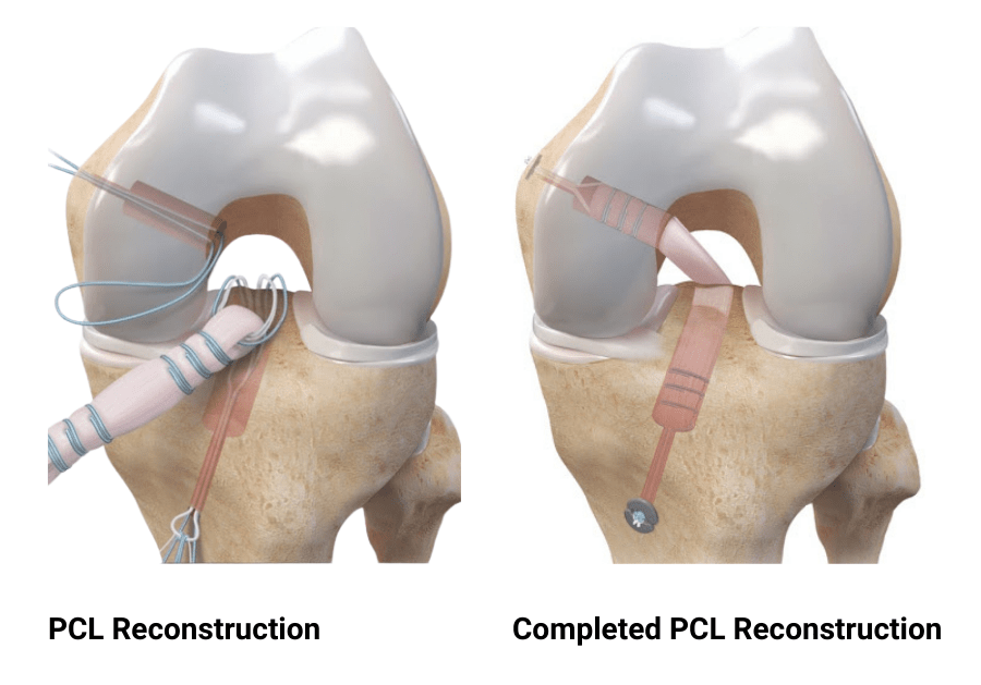 PCL Reconstruction