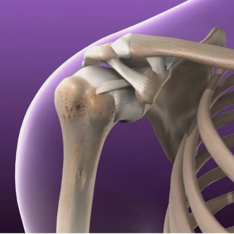 Recurrent Shoulder Dislocation