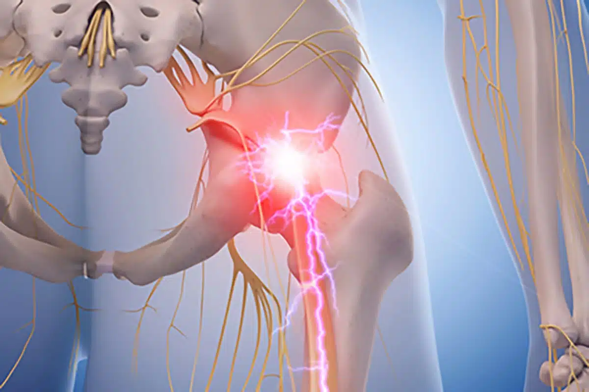 Sciatica & Radiculopathy