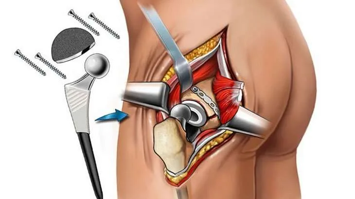 Best Hip Replacement Surgeon Kolkata - Dr. Vikrant Sinha Roy