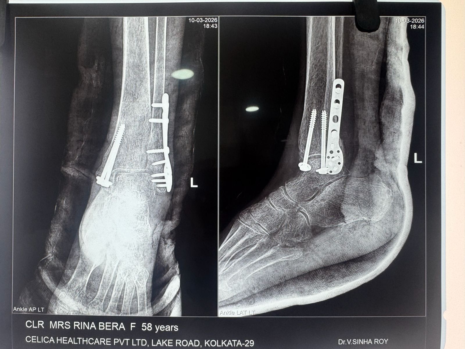 Post-op ankle plate fixation