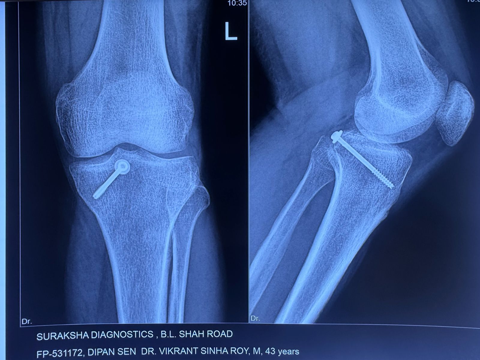 Pre-op shoulder trauma