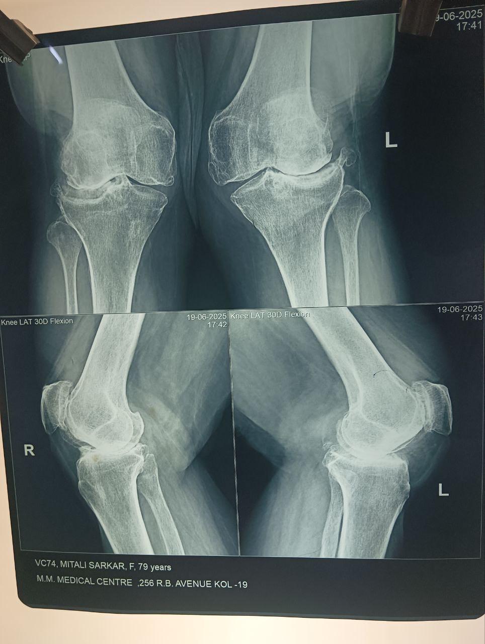 Pre-op bilateral knees