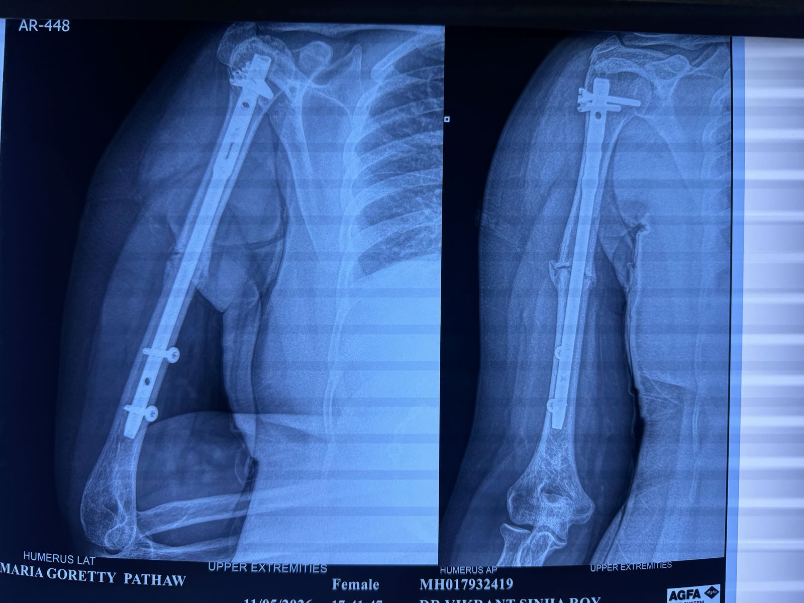 Post-op stabilized humerus