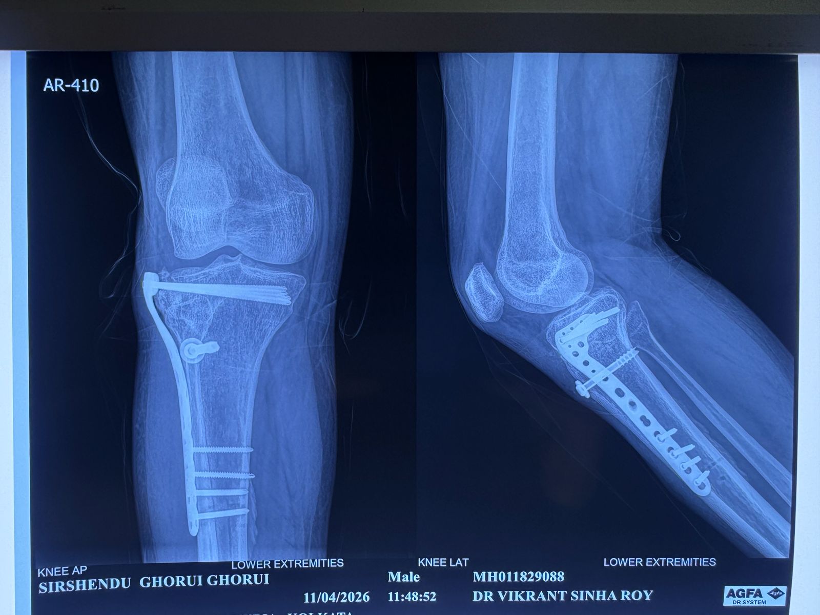 Post-op bilateral knees replacement