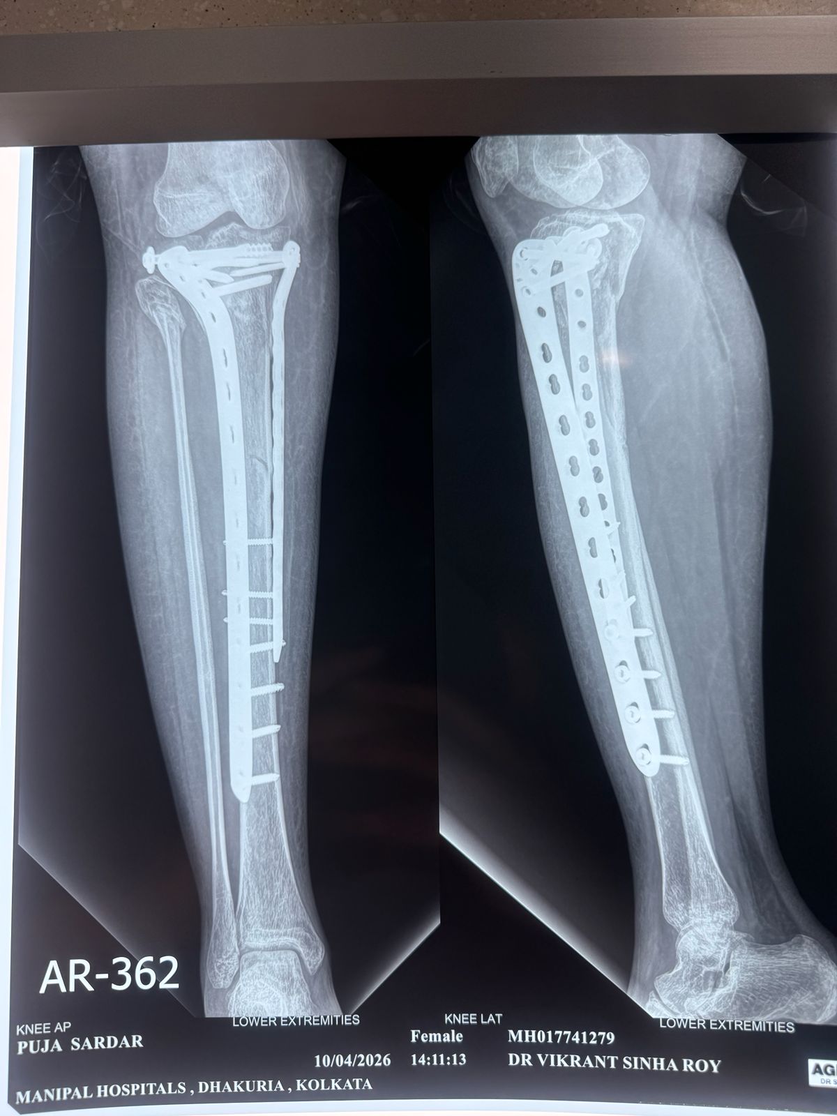 Pre-op fracture alignment