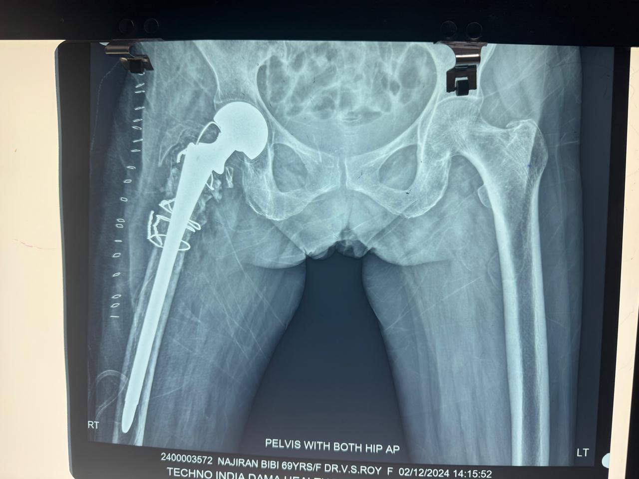Post-op total hip replacement