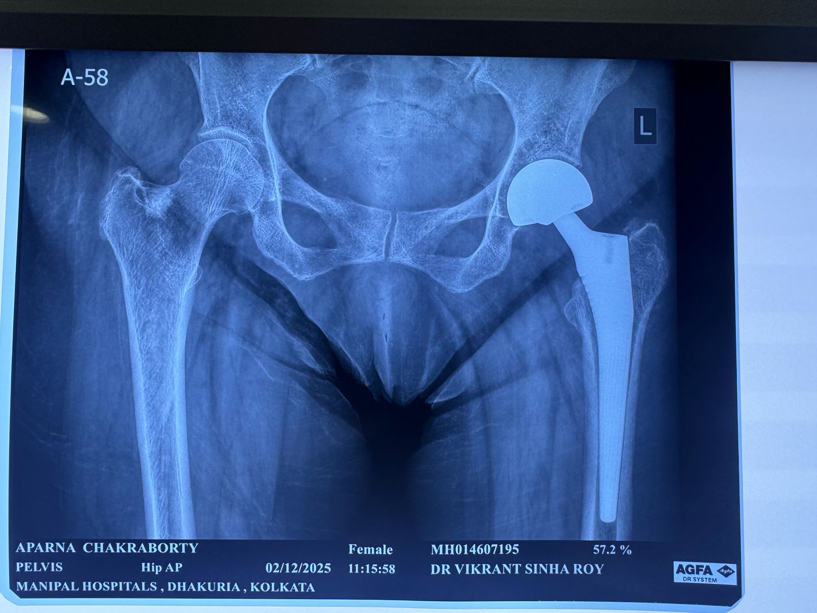 Pre-op pelvic AVN